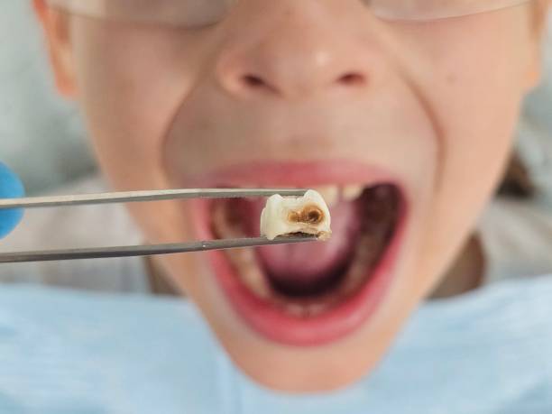 Best Emergency Tooth Extraction in Star, ID